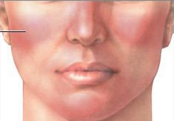 Rosacea